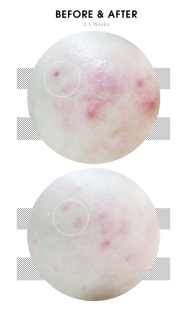 Get Rid Of Acne Scars Fast - 23YearsOld Badecasil Cream 7 in 1 Review