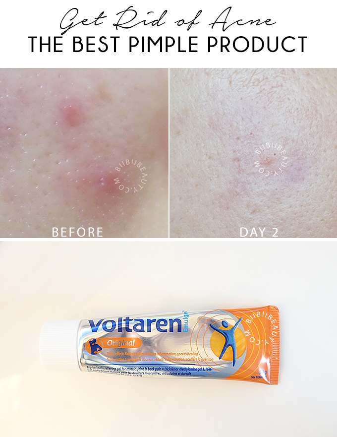 GET RID OF ACNE | The Best Pimple Product