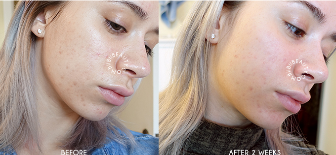 Vivant Skincare 8% Mandelic Acid Serum Review | A Must Have Acne Treatment