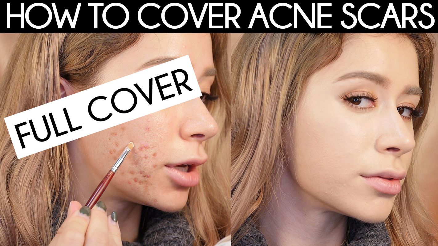 how to cover acne scars without makeup